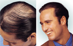 Hair implant Helsinki Turku Lahti