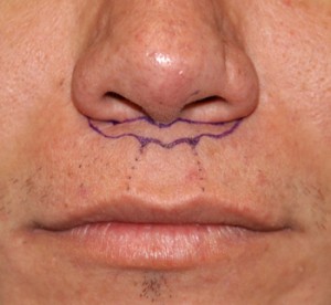 Lip lift Helsinki Finland Buffaloplasty