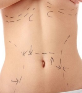 liposuction Helsinki Finland price