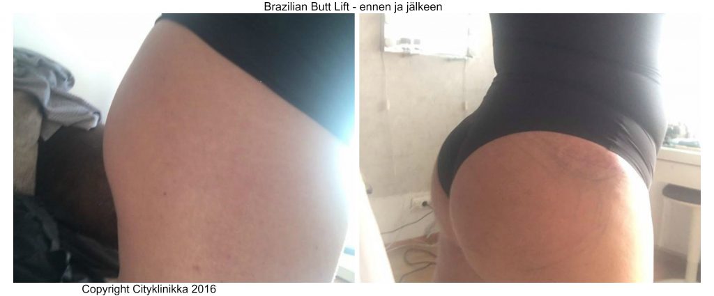 Brazilian Butt Lift Cityklinikka